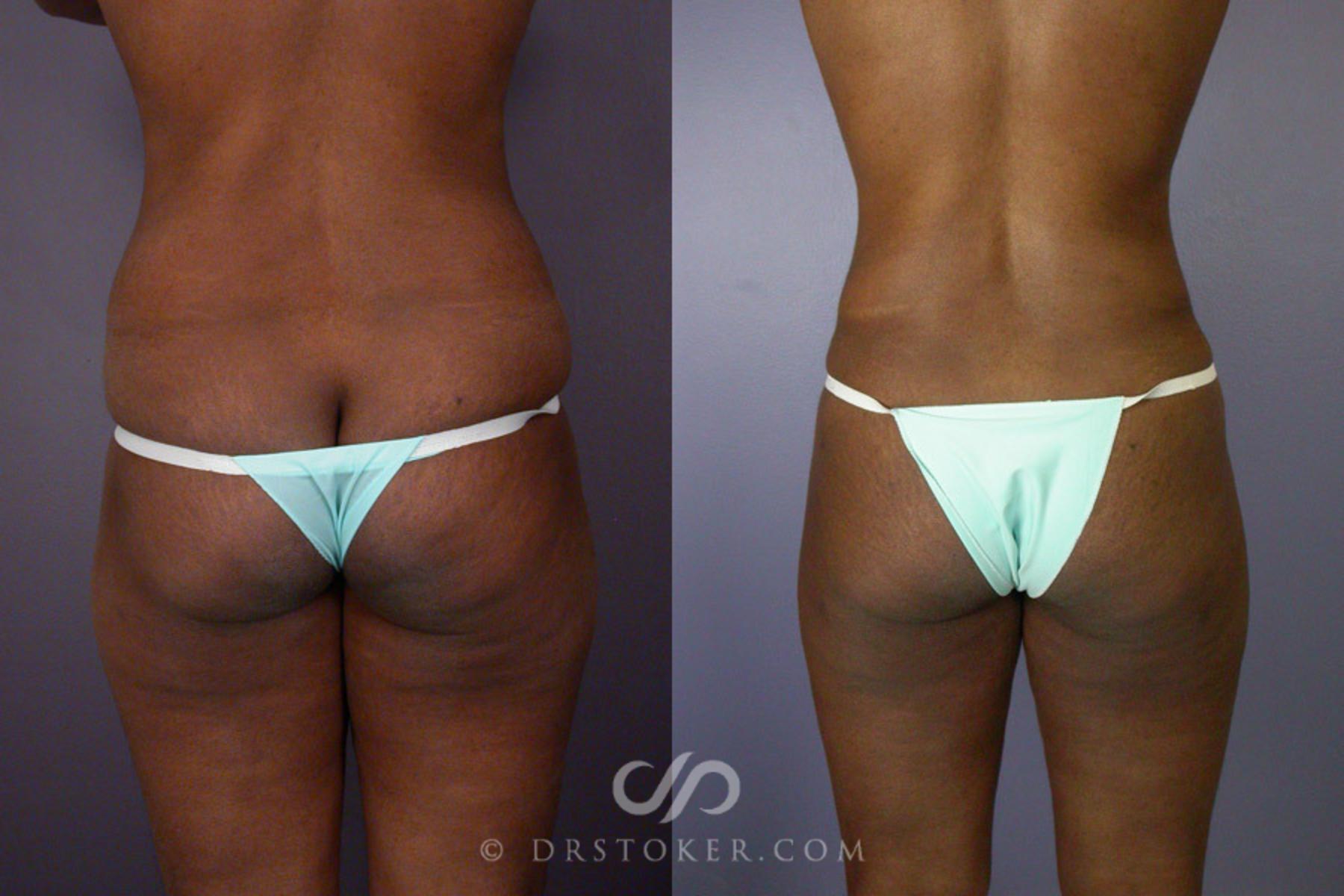 Before & After Tummy Tuck Case 239 View #9 View in Los Angeles, CA
