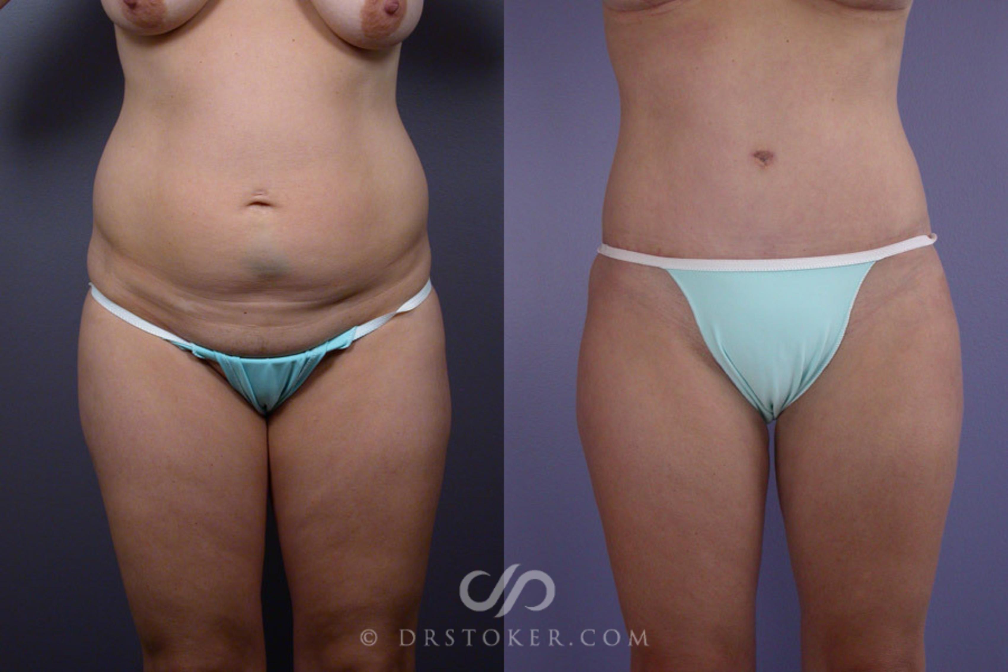 Before & After Tummy Tuck Case 242 View #1 View in Los Angeles, CA