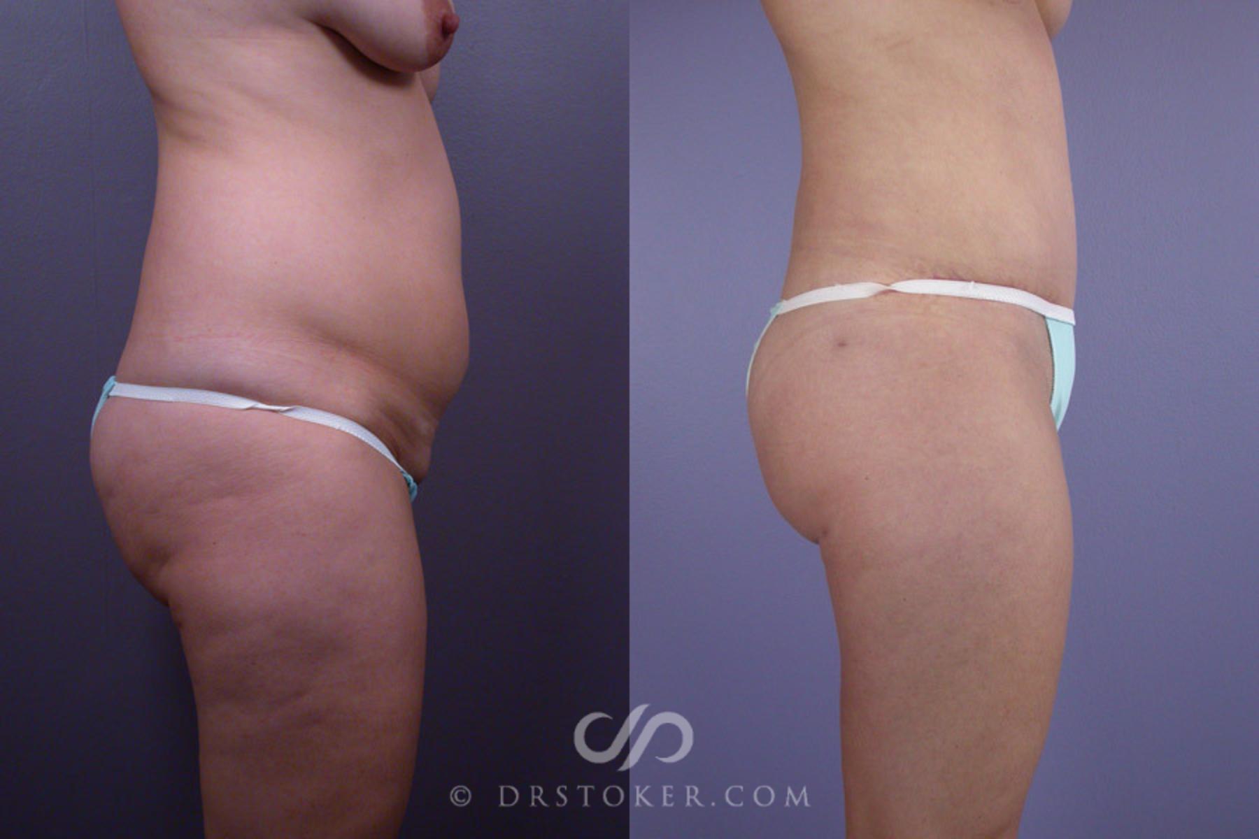 Before & After Liposuction Case 242 View #2 View in Los Angeles, CA