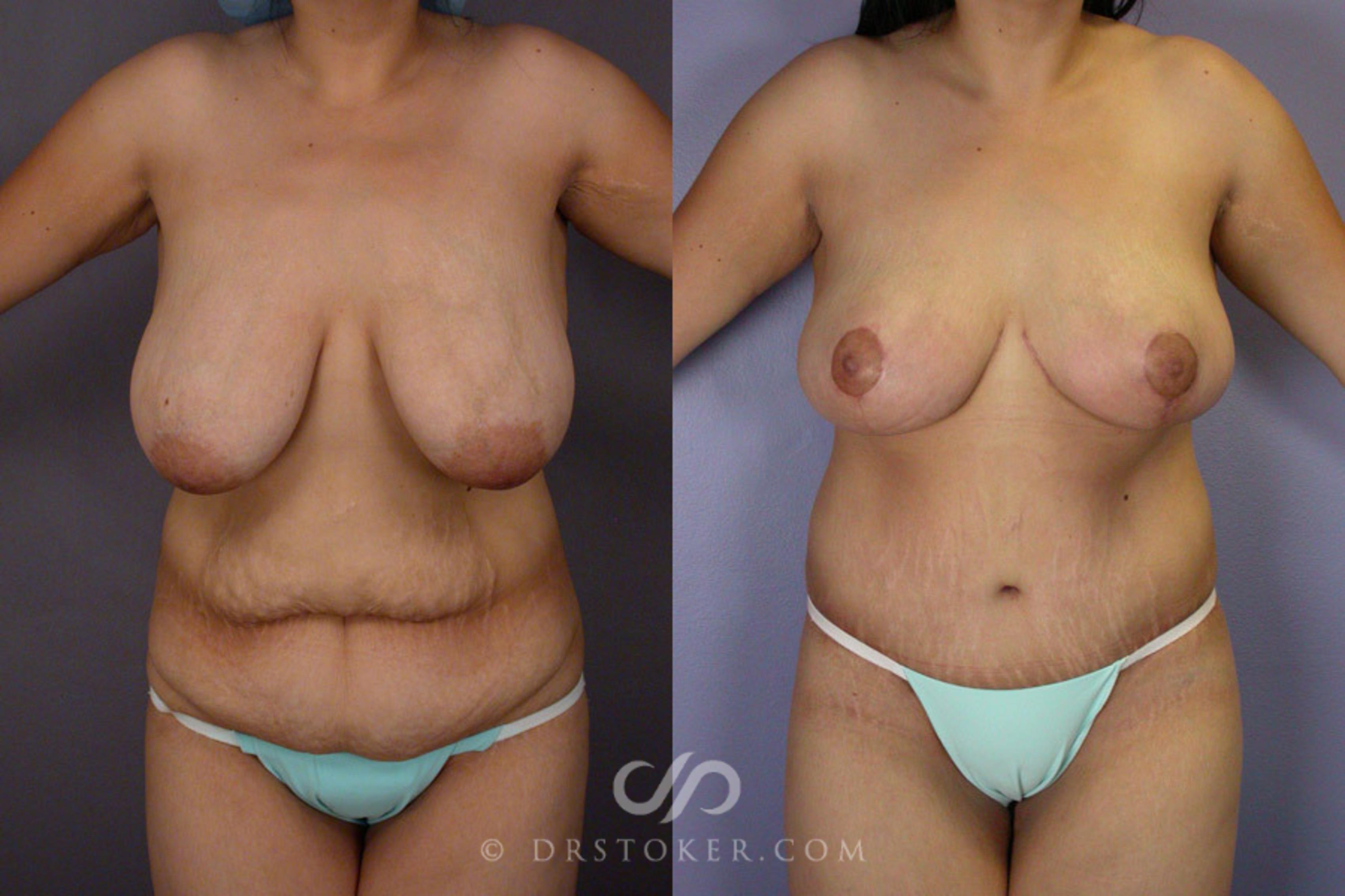 Before & After Tummy Tuck Case 243 View #1 View in Los Angeles, CA