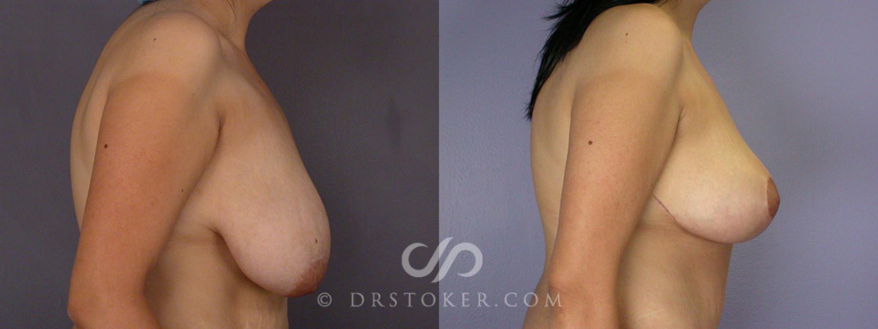 Before & After Tummy Tuck Case 243 View #10 View in Los Angeles, CA