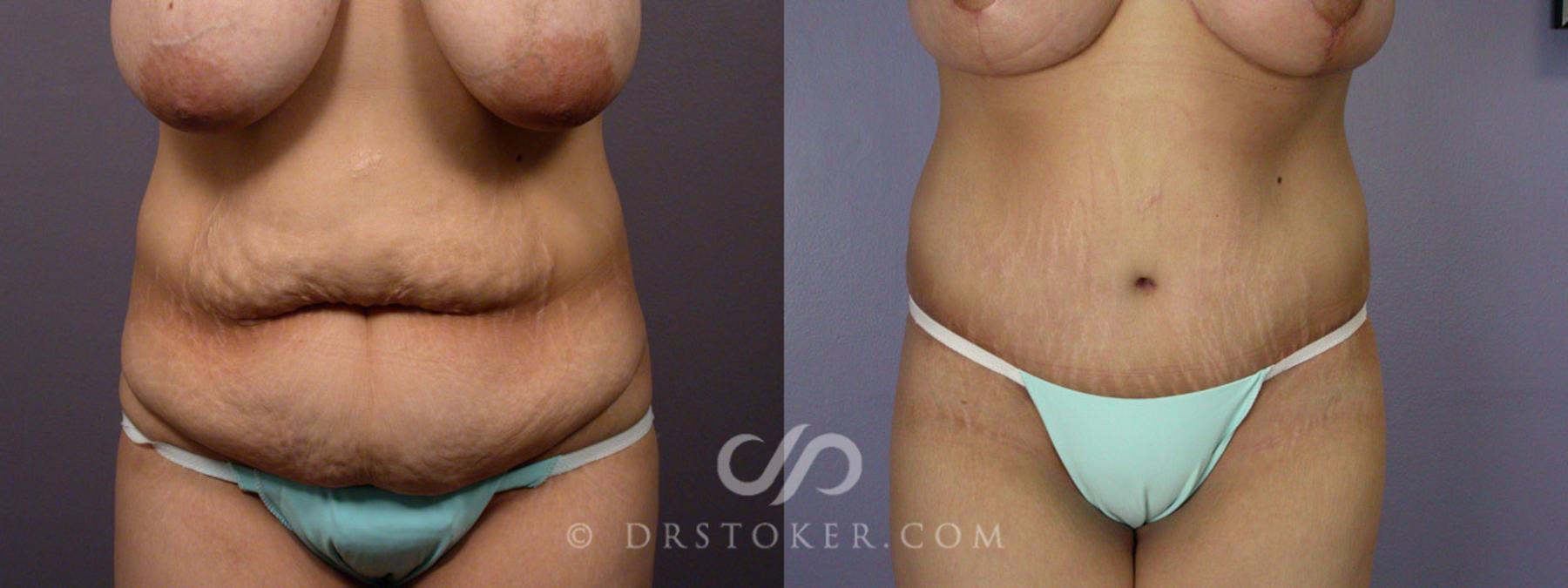 Before & After Tummy Tuck Case 243 View #2 View in Los Angeles, CA