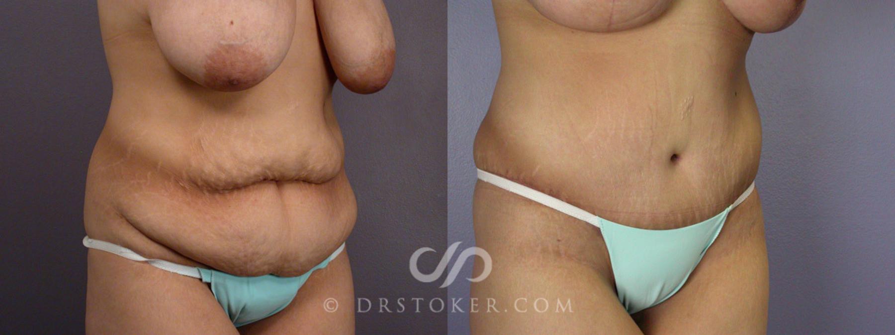 Before & After Tummy Tuck Case 243 View #3 View in Los Angeles, CA