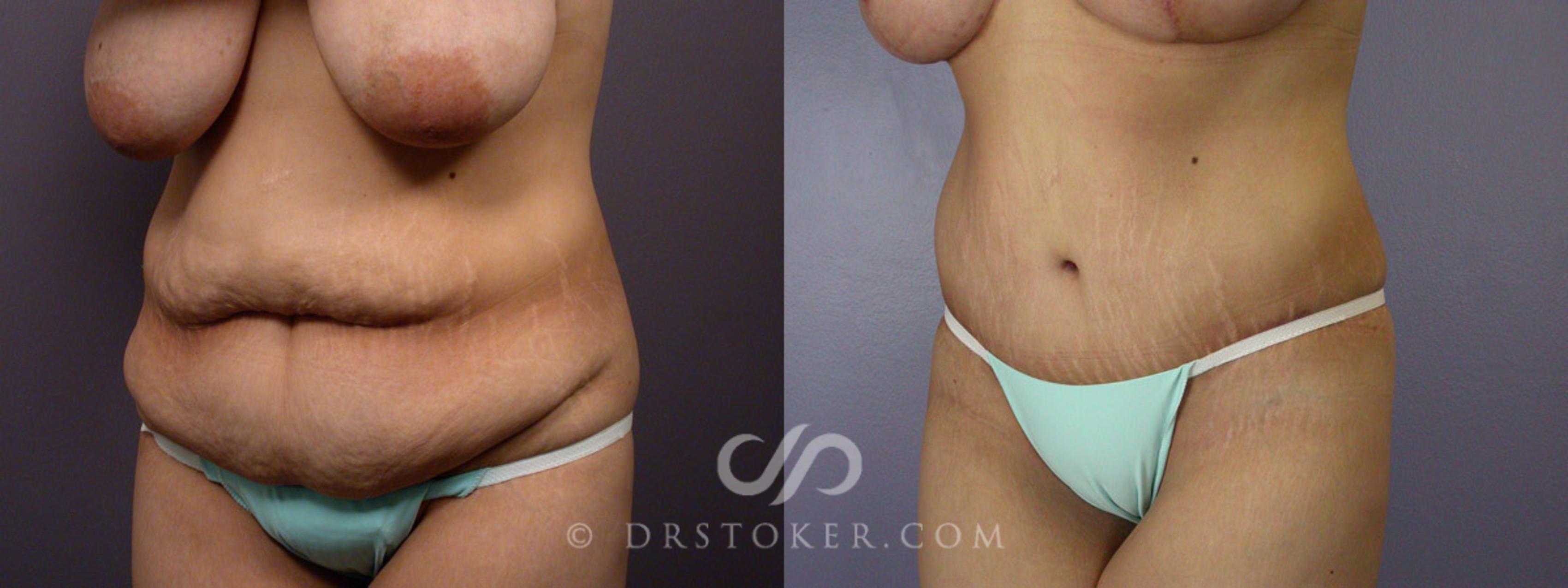 Before & After Tummy Tuck Case 243 View #4 View in Los Angeles, CA