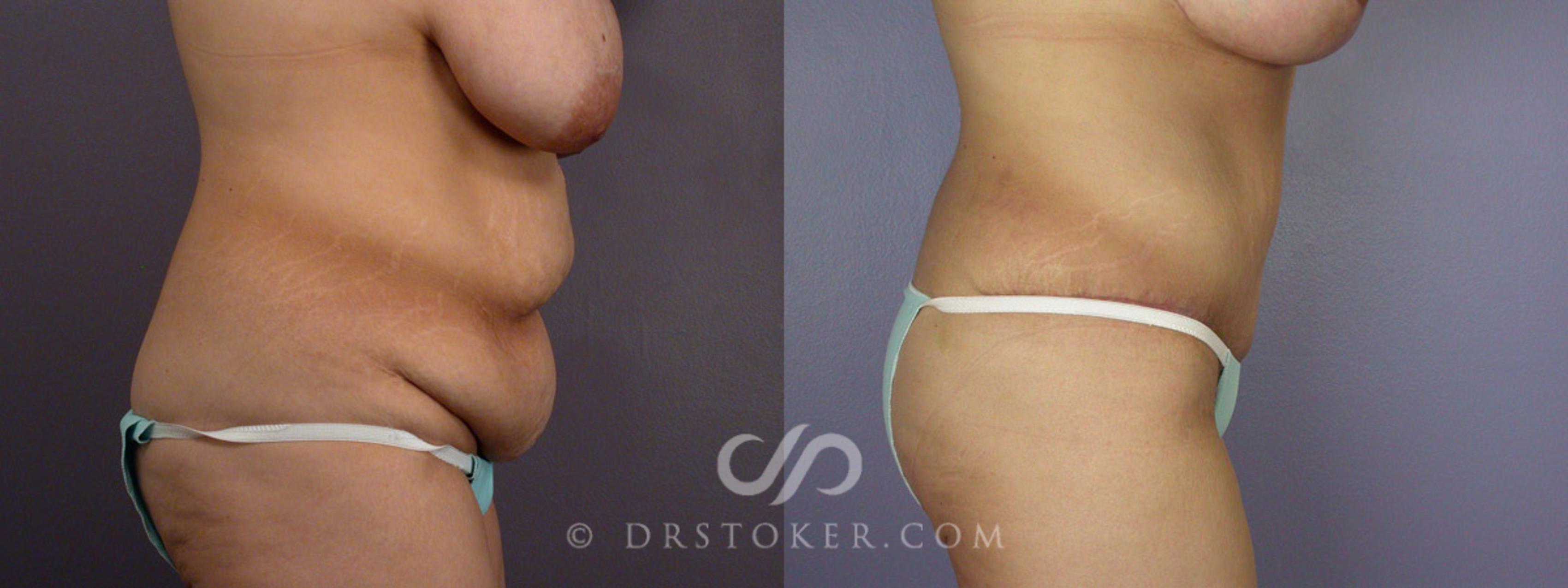 Before & After Breast Reduction (for Women) Case 243 View #5 View in Los Angeles, CA