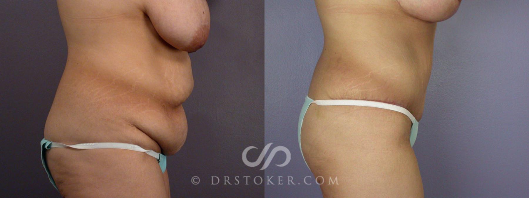 Before & After Breast Lift Case 243 View #5 View in Los Angeles, CA