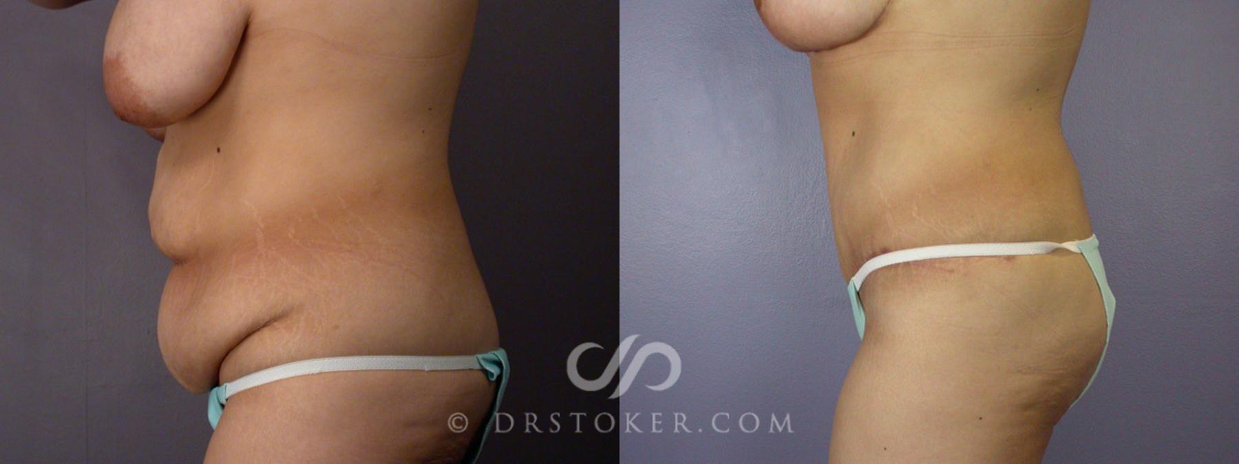 Before & After Breast Reduction (for Women) Case 243 View #6 View in Los Angeles, CA