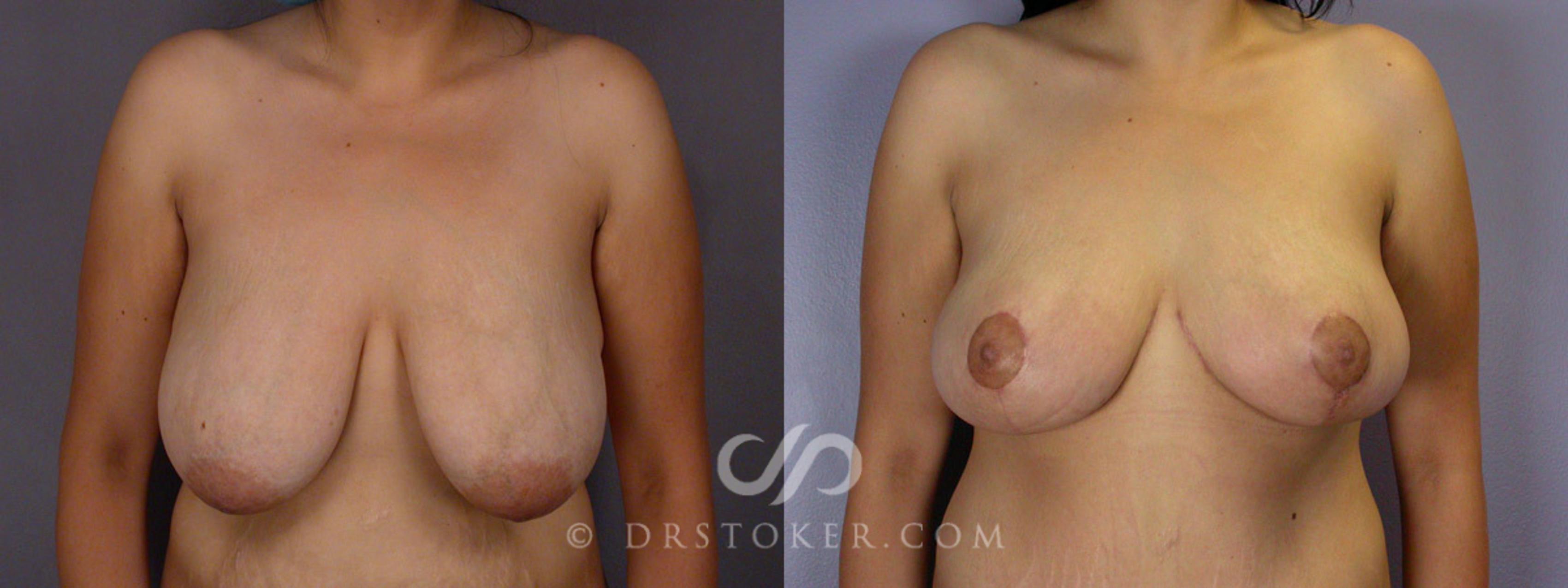 Before & After Breast Reduction (for Women) Case 243 View #7 View in Los Angeles, CA