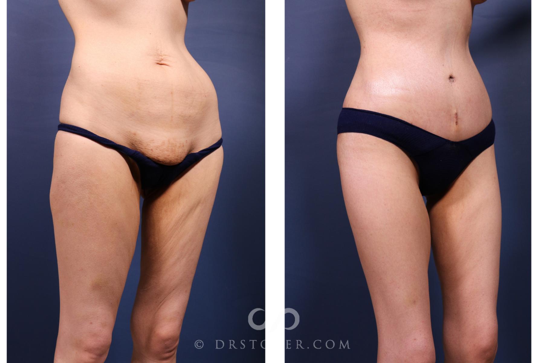 Before & After Tummy Tuck Case 2642 Right Oblique View in Los Angeles, CA