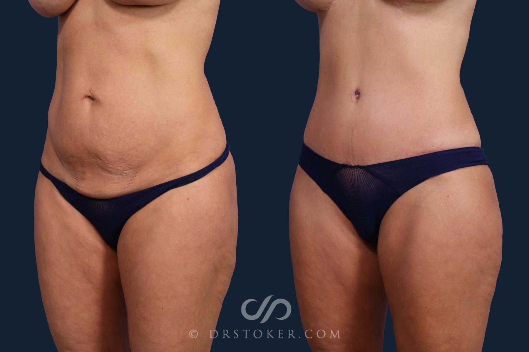 Before & After Tummy Tuck Case 2649 Left Oblique View in Los Angeles, CA