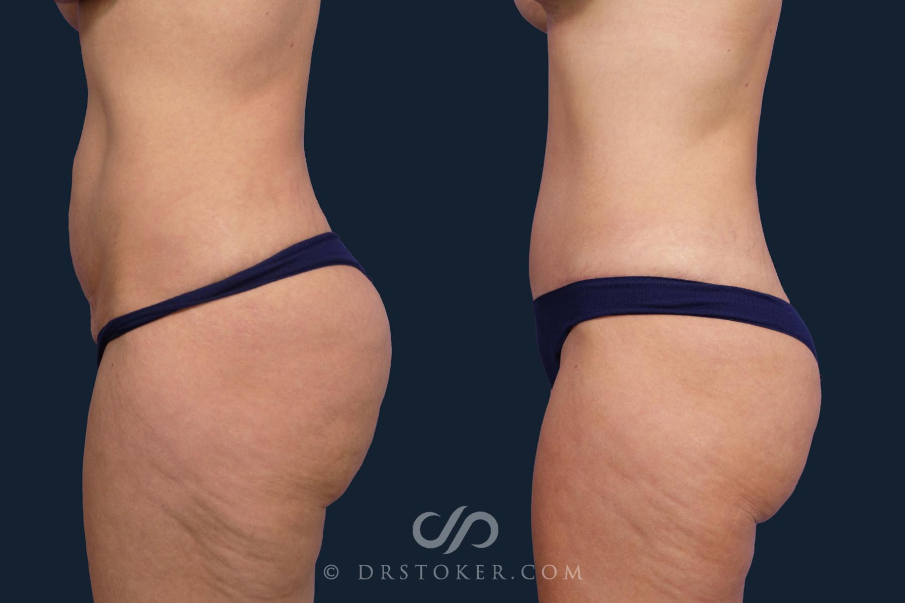 Before & After Tummy Tuck Case 2649 Left Side View in Los Angeles, CA