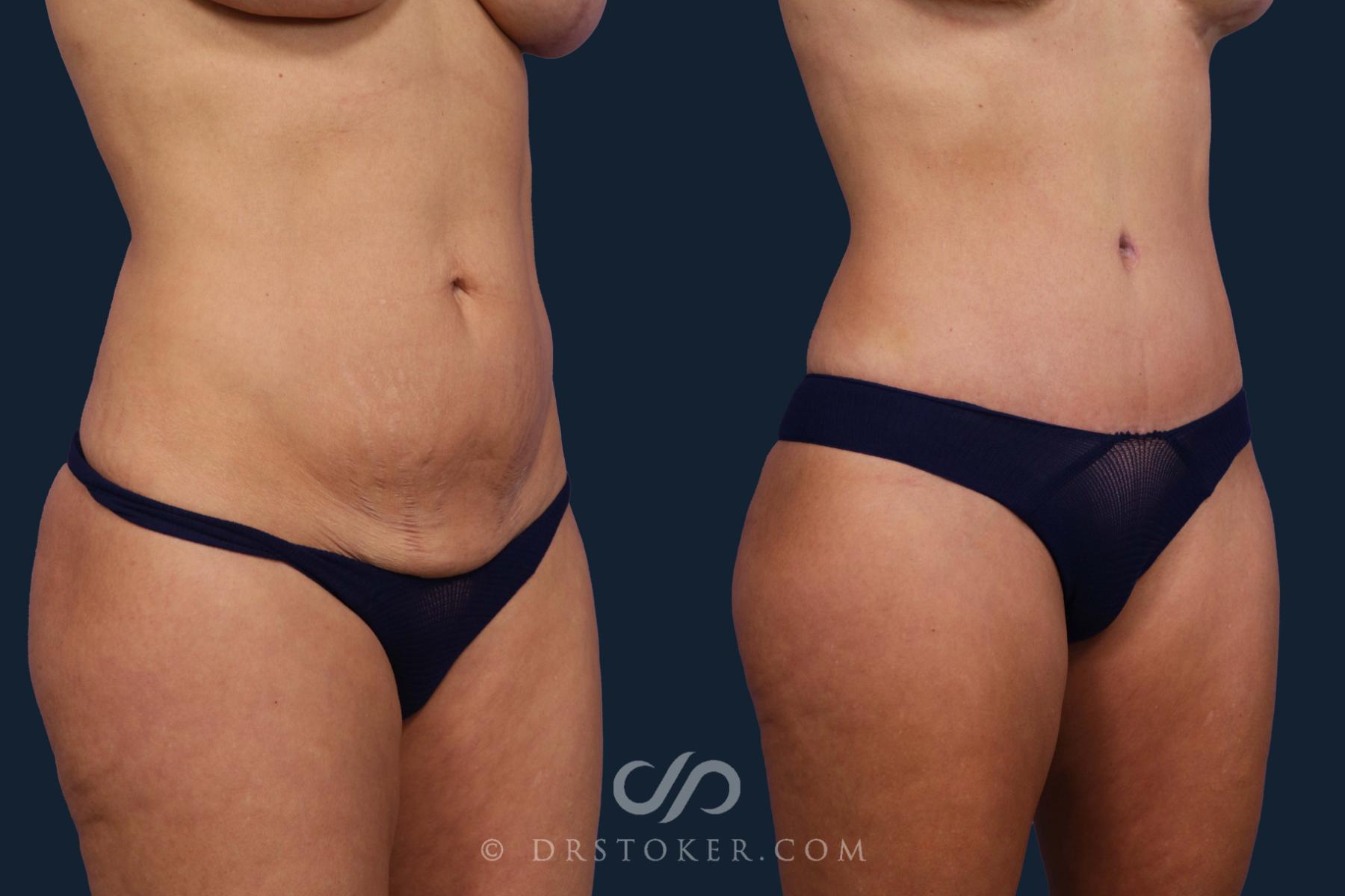 Before & After Tummy Tuck Case 2649 Right Oblique View in Los Angeles, CA