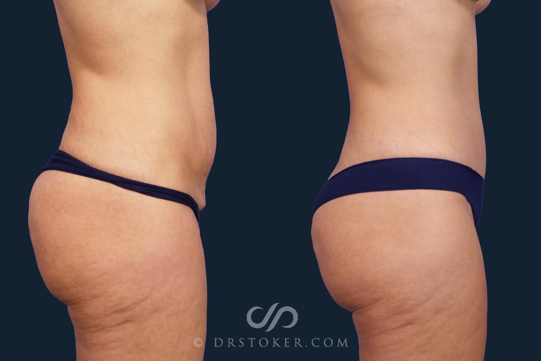 Before & After Tummy Tuck Case 2649 Right Side View in Los Angeles, CA
