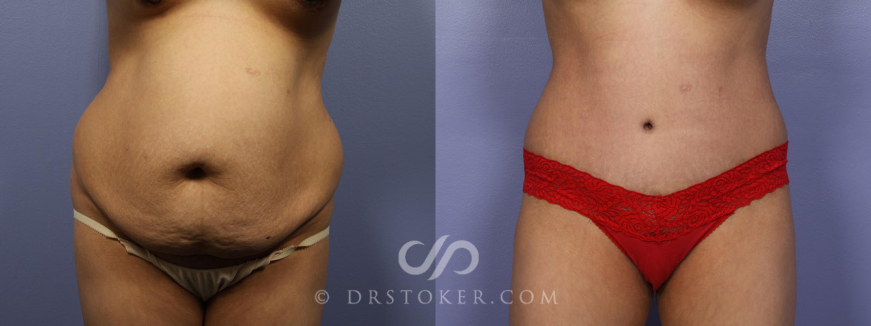 Before & After Tummy Tuck Case 327 View #1 View in Los Angeles, CA