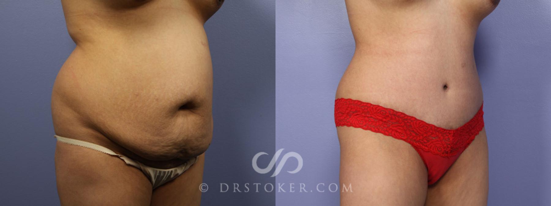 Before & After Tummy Tuck Case 327 View #2 View in Los Angeles, CA