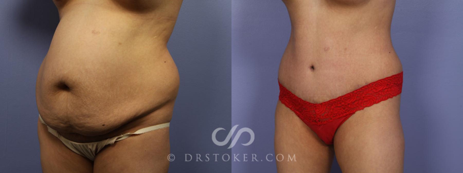 Before & After Tummy Tuck Case 327 View #3 View in Los Angeles, CA