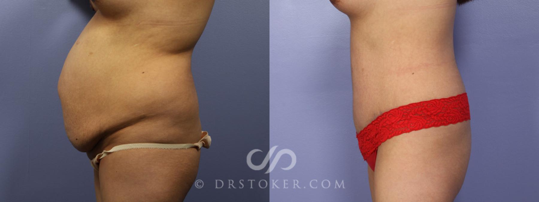 Before & After Tummy Tuck Case 327 View #6 View in Los Angeles, CA