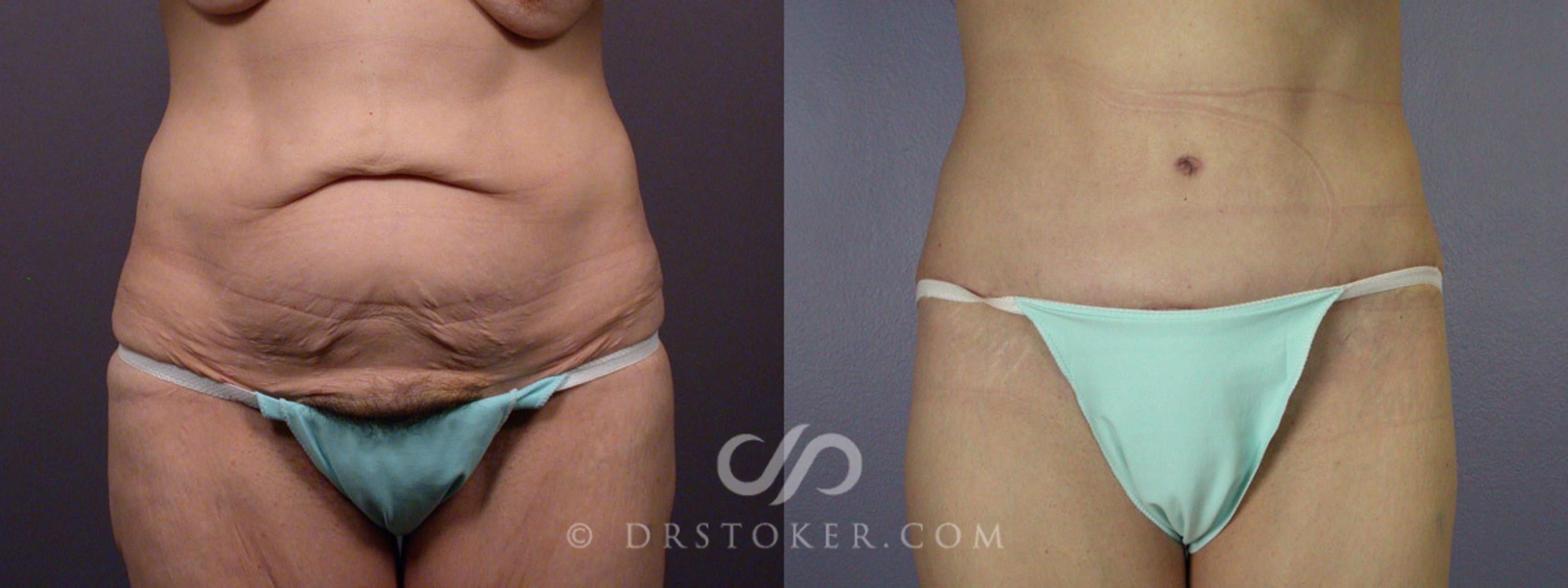 Before & After Tummy Tuck Case 328 View #1 View in Los Angeles, CA