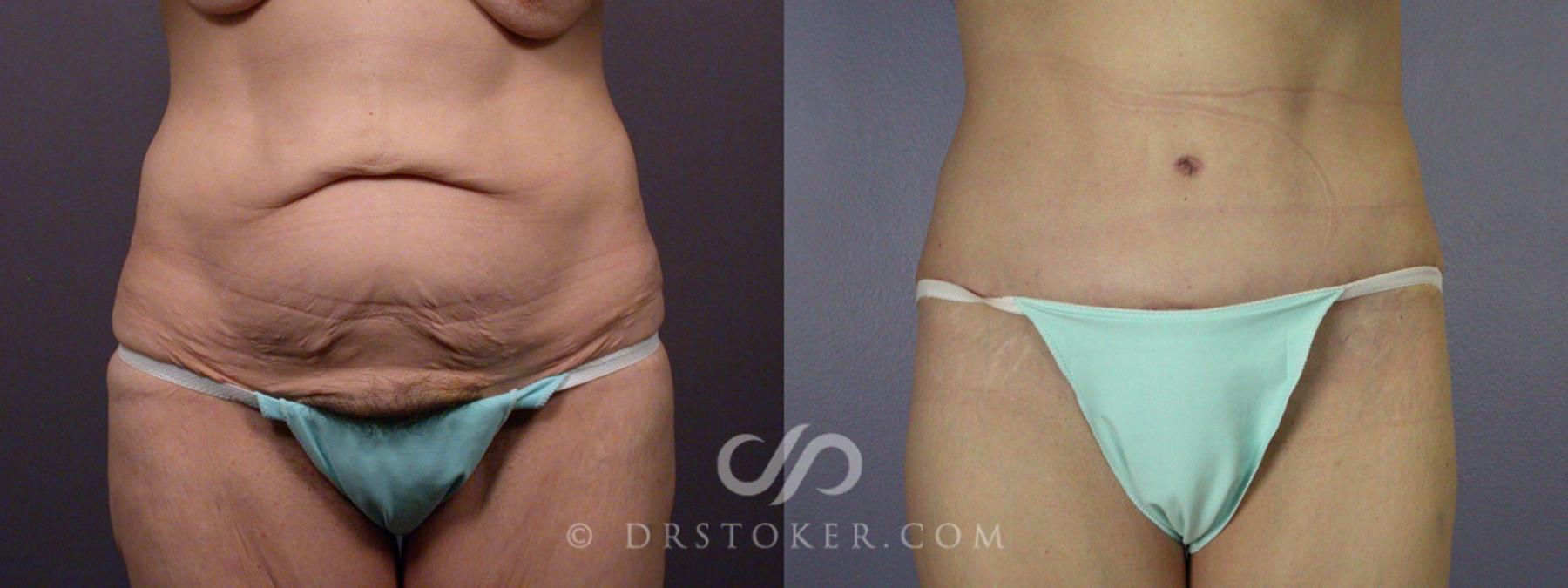 Before & After Body Lift Case 328 View #1 View in Los Angeles, CA