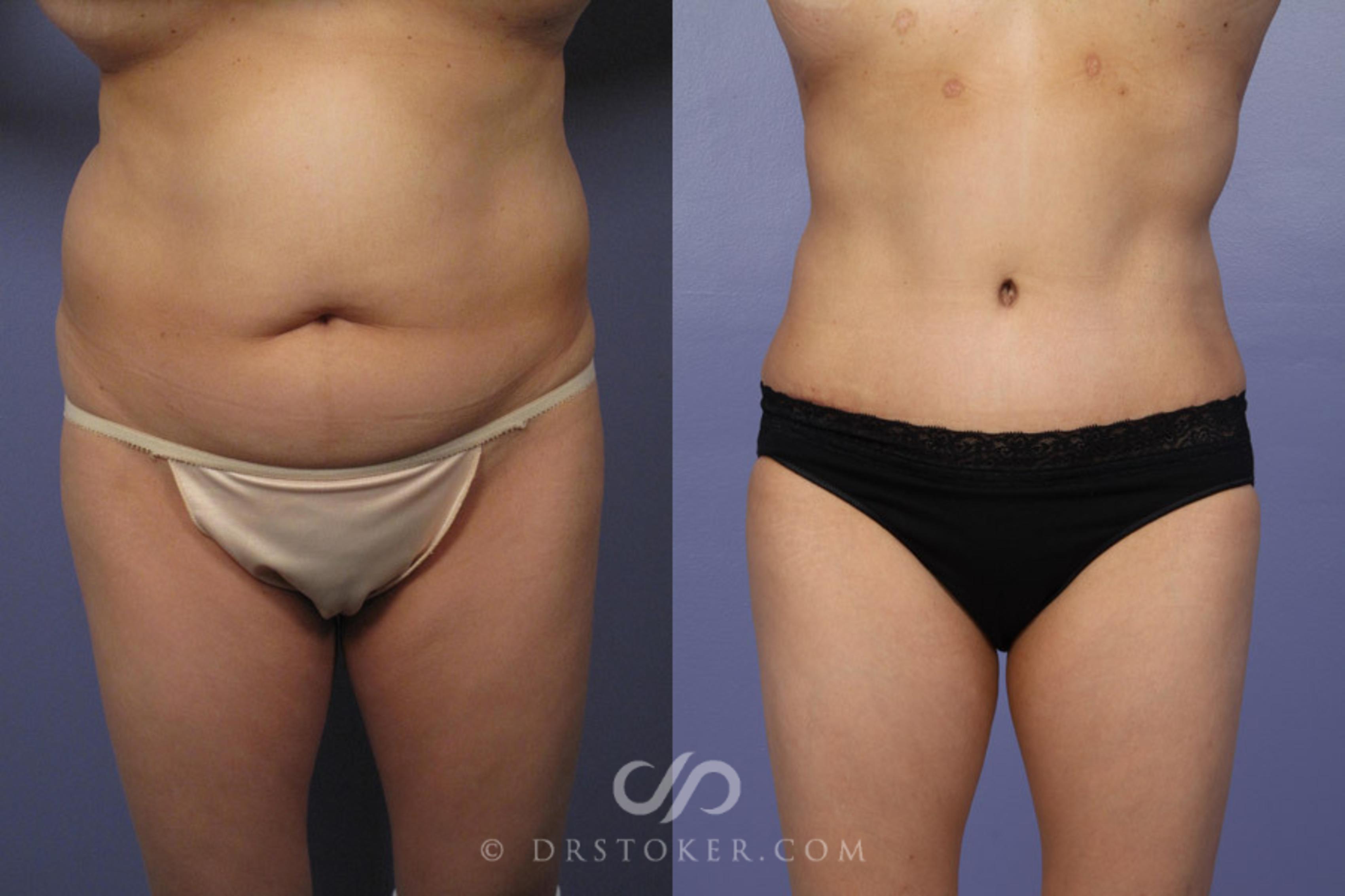 Before & After Tummy Tuck Case 336 View #1 View in Los Angeles, CA