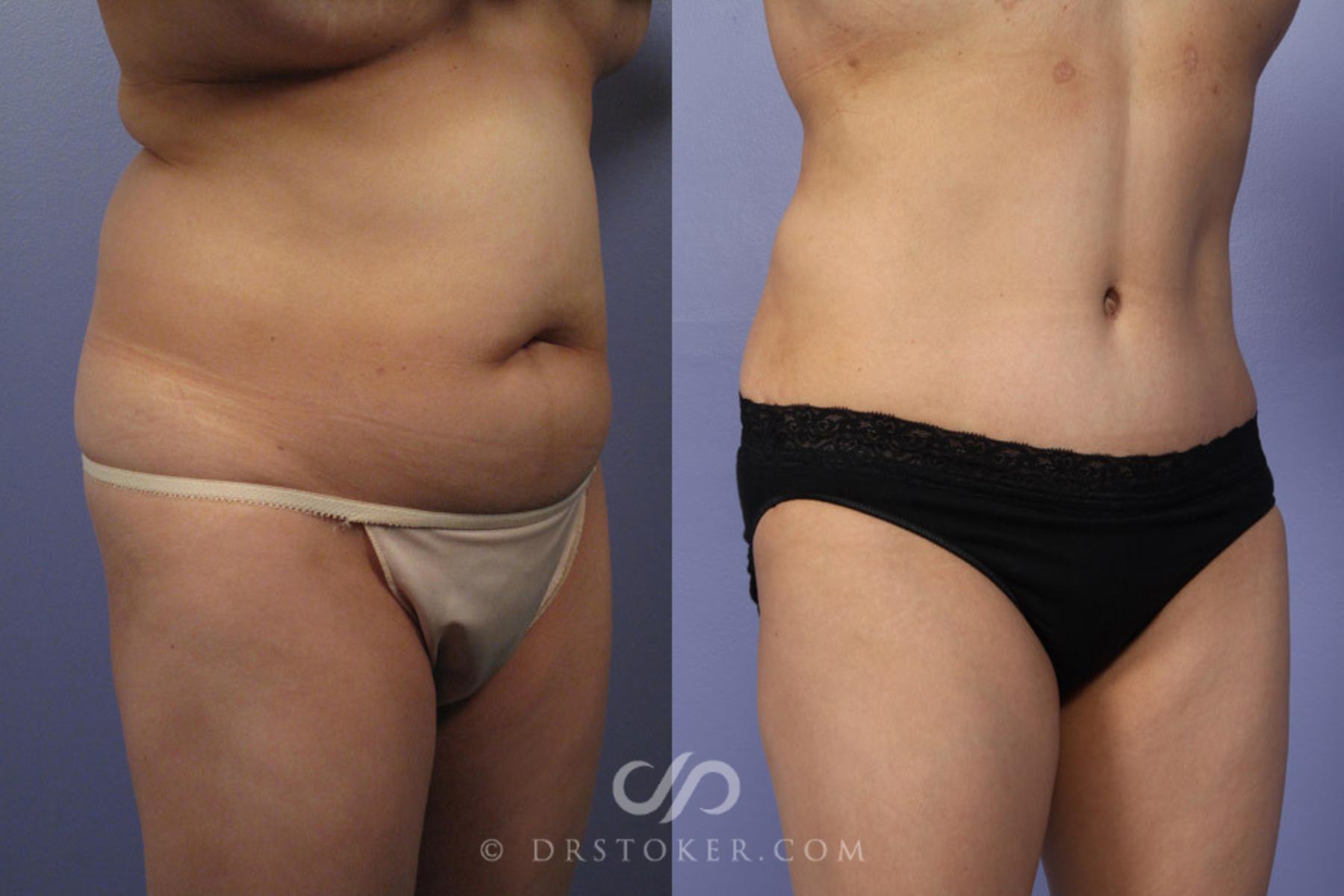 Before & After Tummy Tuck Case 336 View #2 View in Los Angeles, CA