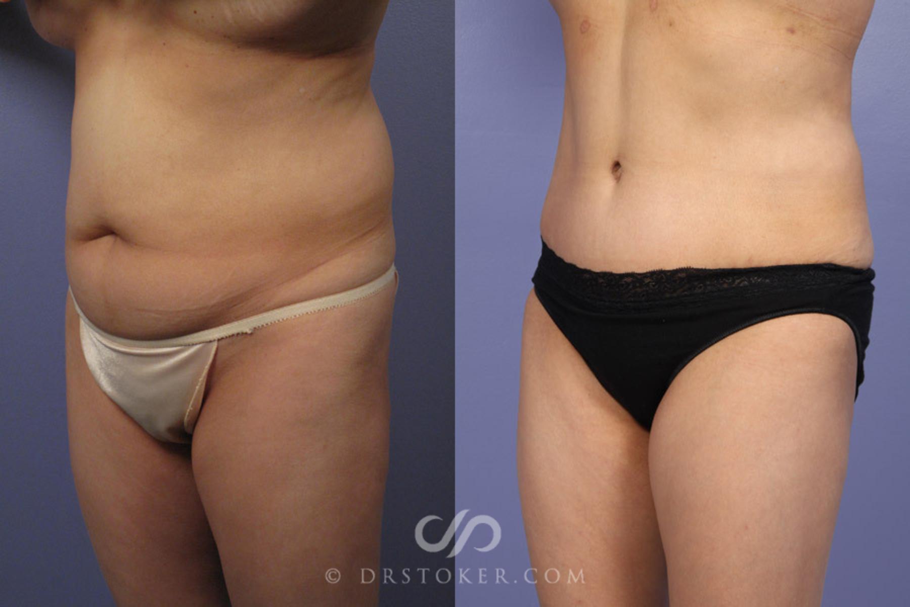 Before & After Tummy Tuck Case 336 View #3 View in Los Angeles, CA