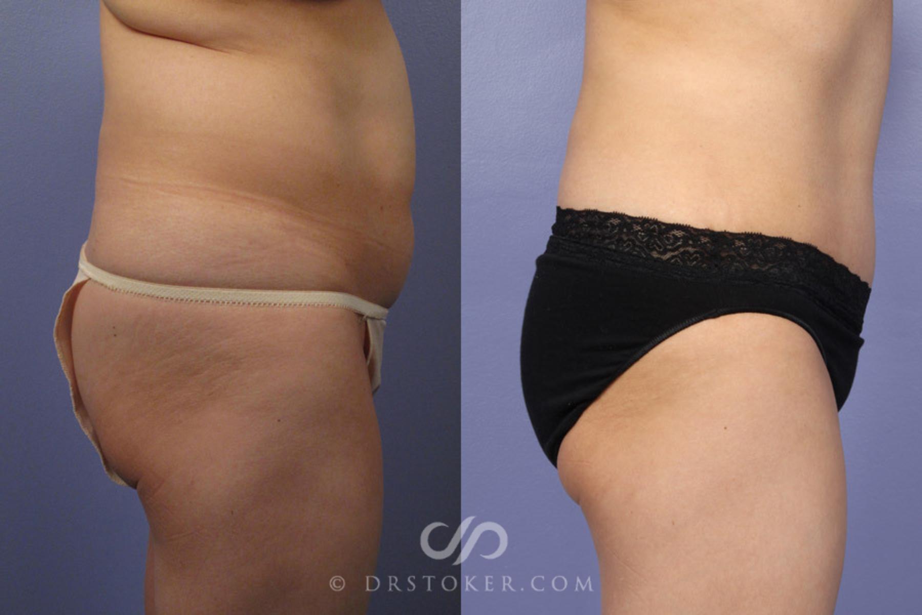 Before & After Tummy Tuck Case 336 View #4 View in Los Angeles, CA