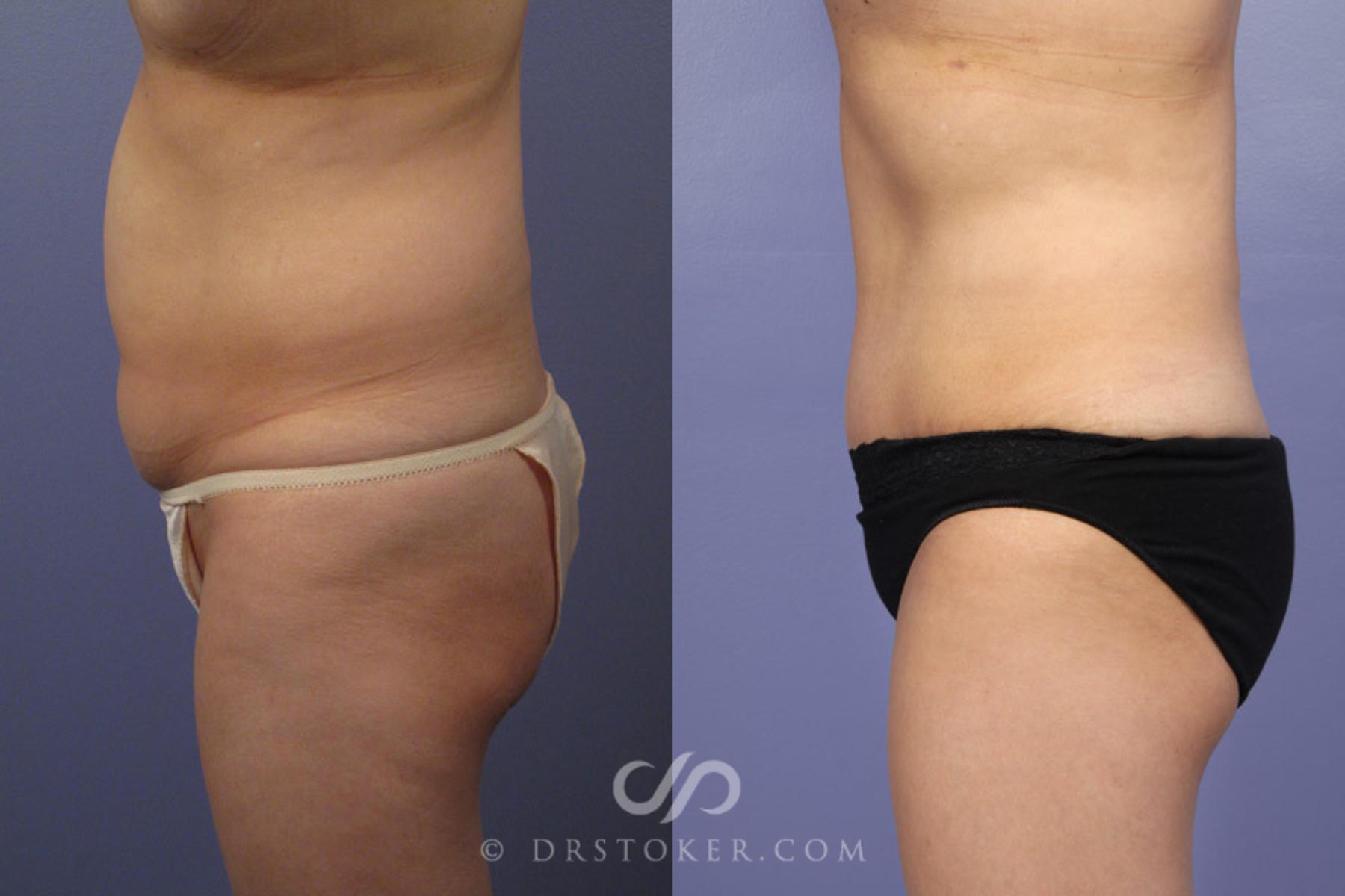 Before & After Tummy Tuck Case 336 View #5 View in Los Angeles, CA