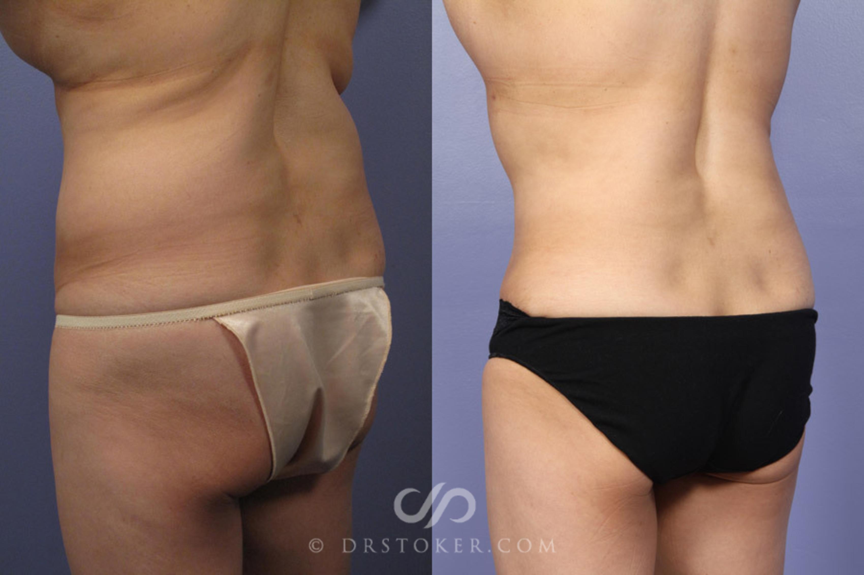 Before & After Tummy Tuck Case 336 View #6 View in Los Angeles, CA