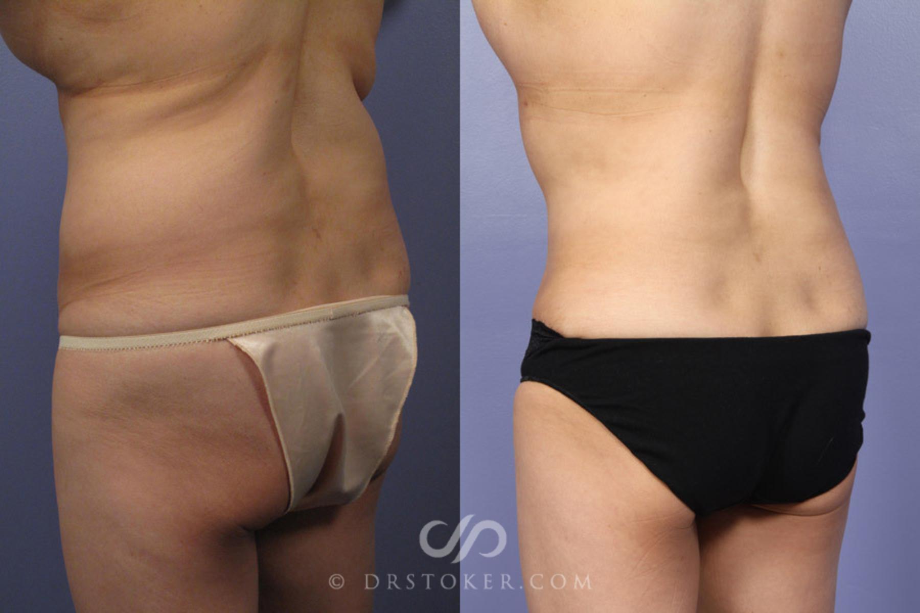 Before & After Tummy Tuck Case 336 View #6 View in Los Angeles, CA