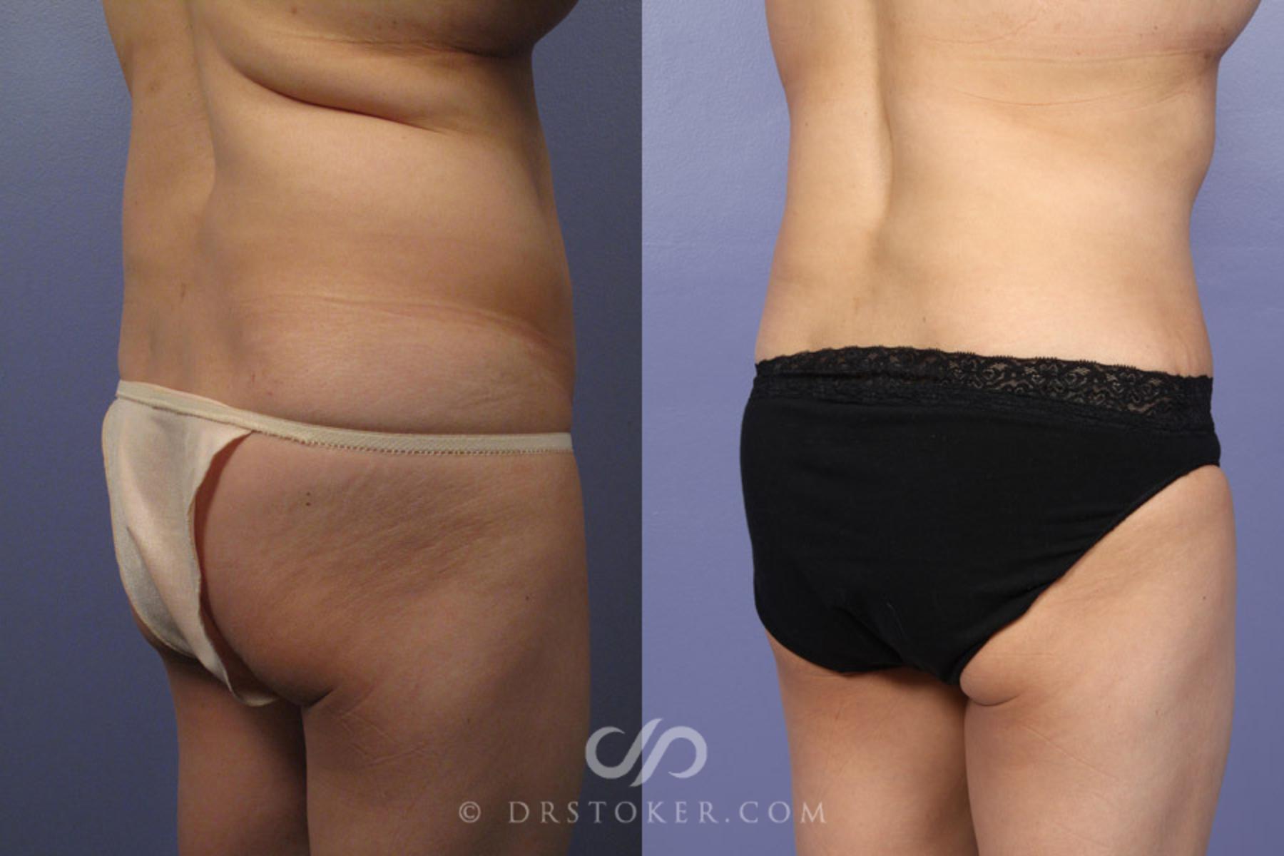 Before & After Tummy Tuck Case 336 View #7 View in Los Angeles, CA