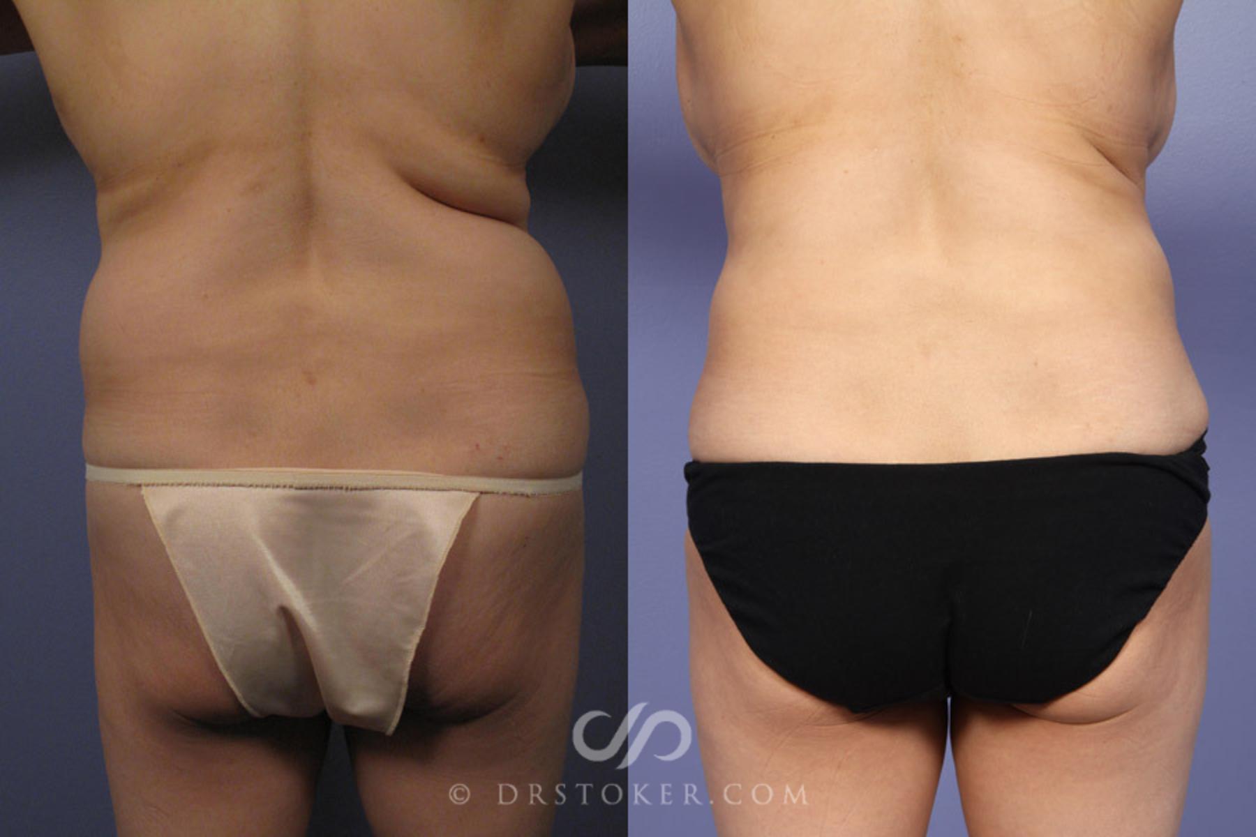 Before & After Tummy Tuck Case 336 View #8 View in Los Angeles, CA