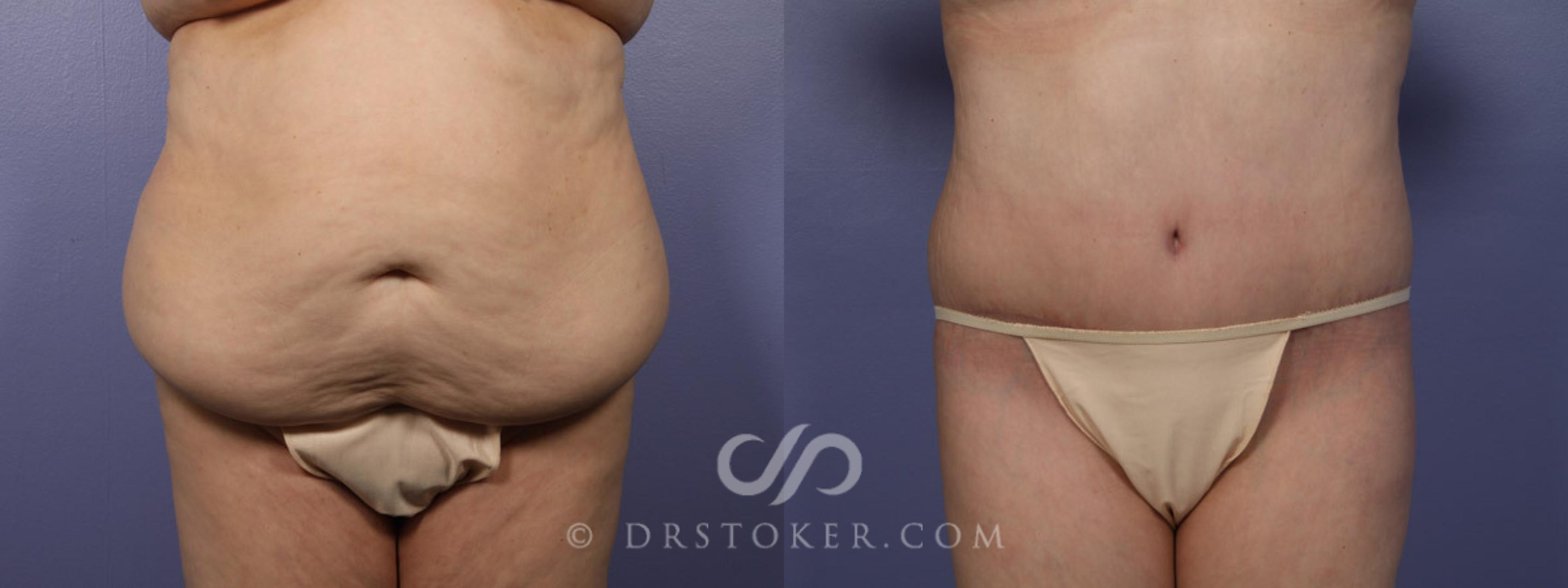 Before & After Tummy Tuck Case 338 View #1 View in Los Angeles, CA