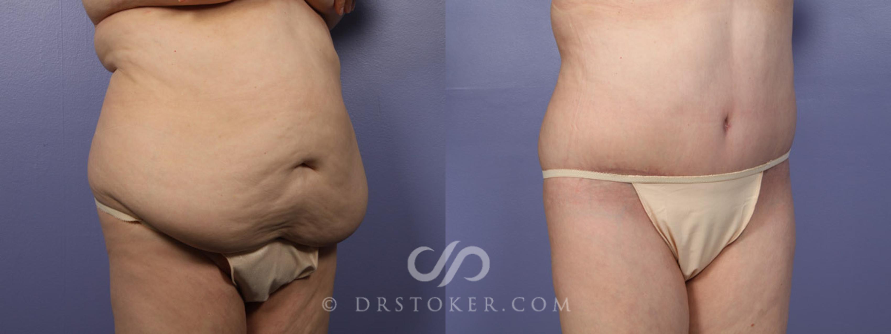 Before & After Tummy Tuck Case 338 View #2 View in Los Angeles, CA