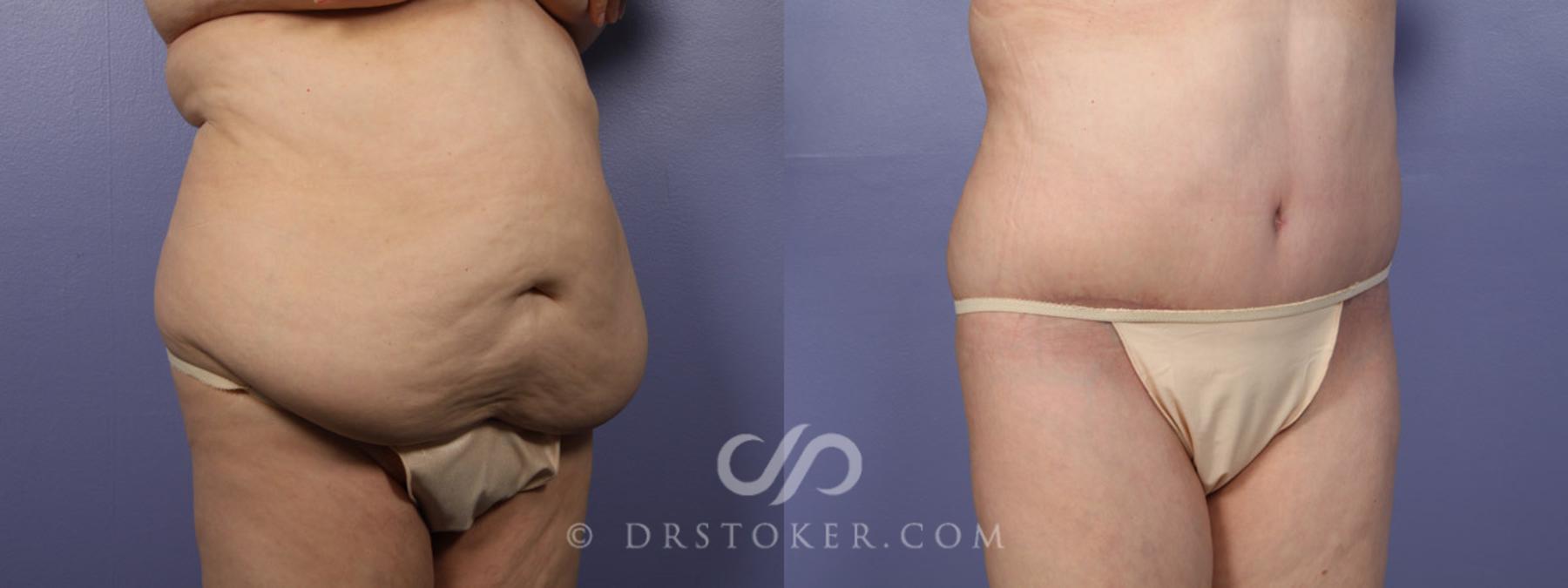 Before & After Tummy Tuck Case 338 View #2 View in Los Angeles, CA