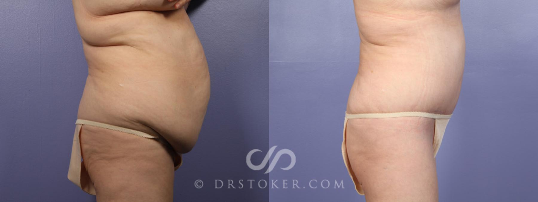 Before & After Tummy Tuck Case 338 View #4 View in Los Angeles, CA