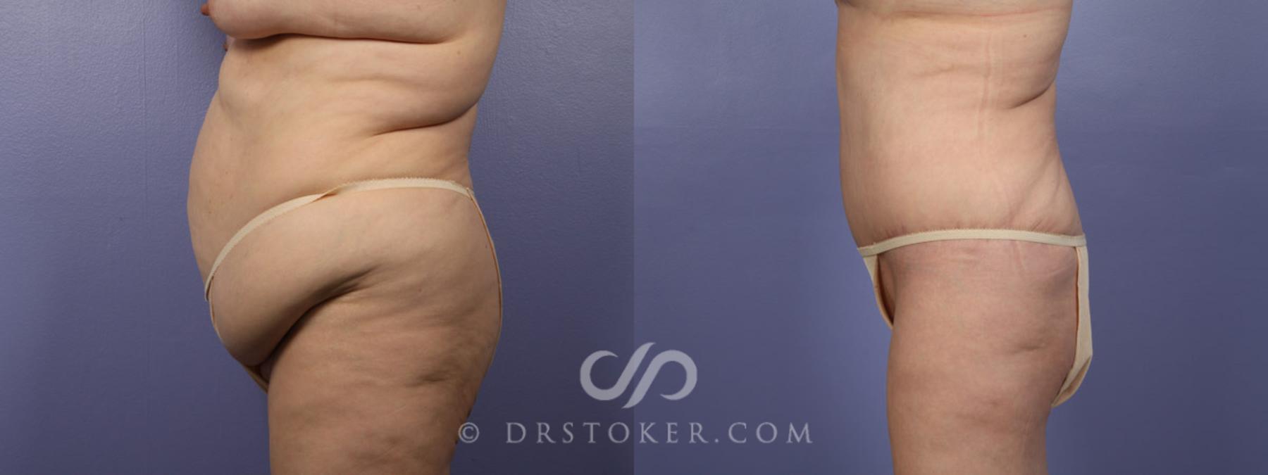 Before & After Tummy Tuck Case 338 View #5 View in Los Angeles, CA