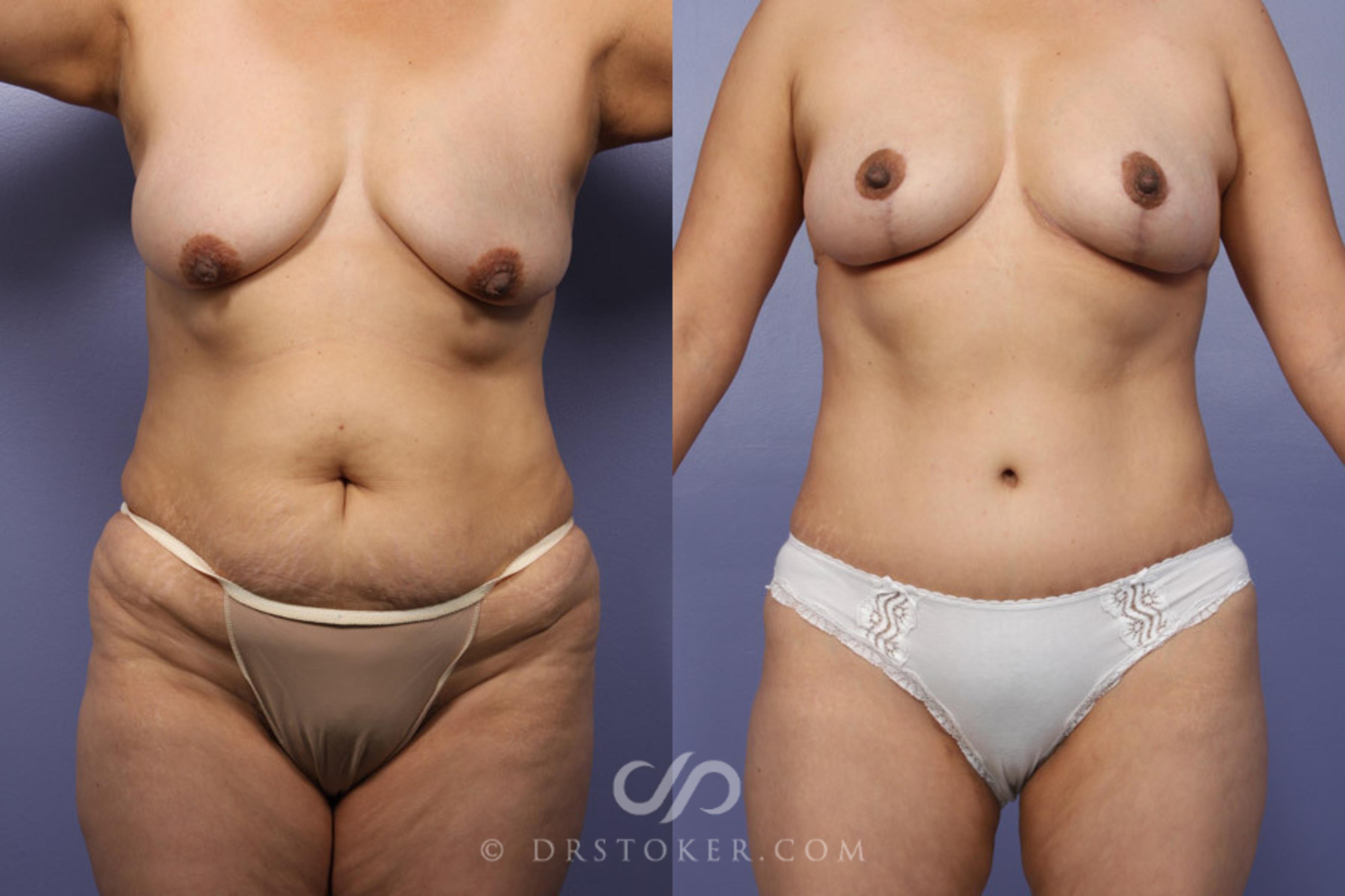 Before & After Tummy Tuck Case 344 View #1 View in Los Angeles, CA