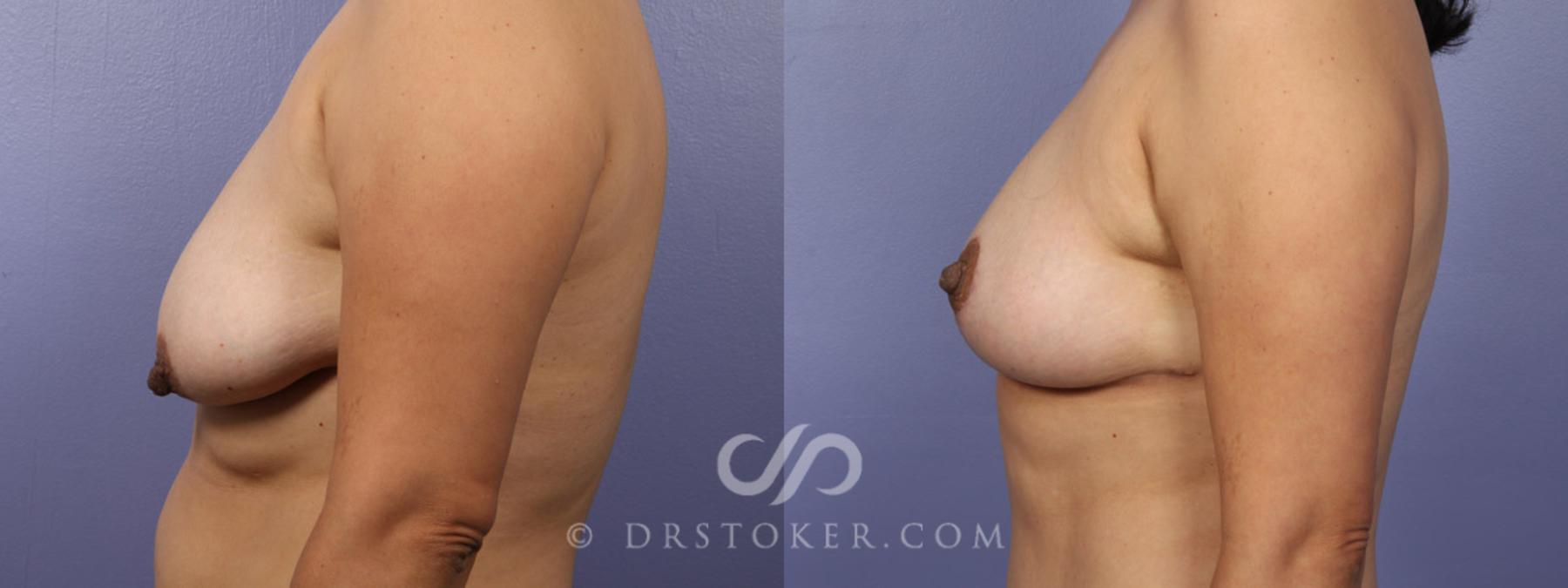 Before & After Tummy Tuck Case 344 View #11 View in Los Angeles, CA