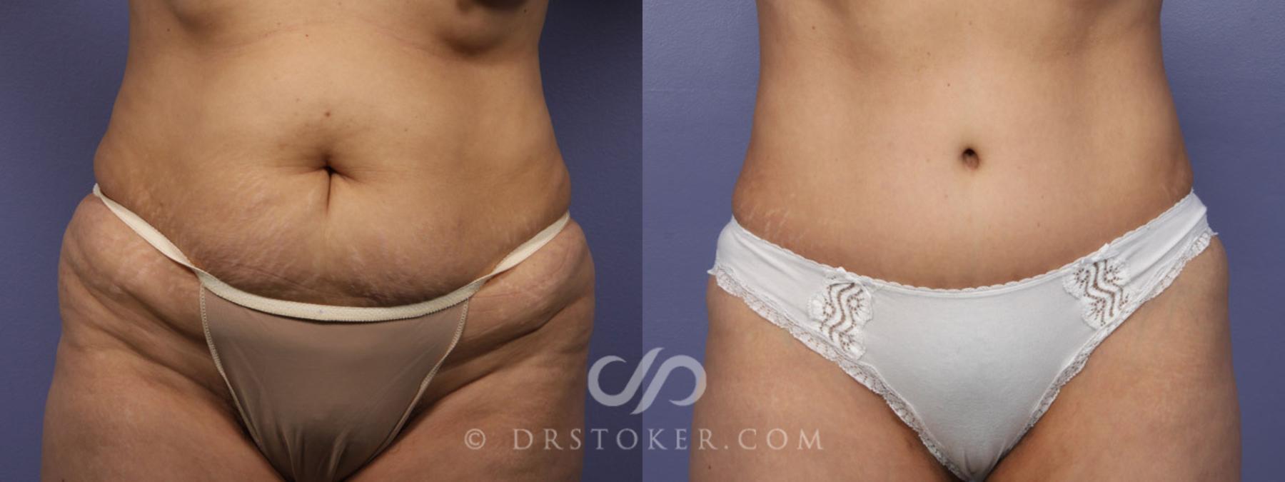 Before & After Breast Lift Case 344 View #12 View in Los Angeles, CA
