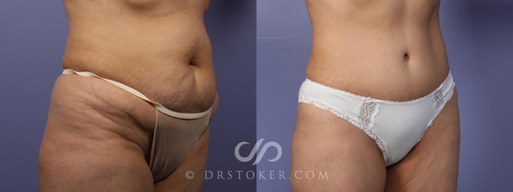 Before & After Tummy Tuck Case 344 View #13 View in Los Angeles, CA