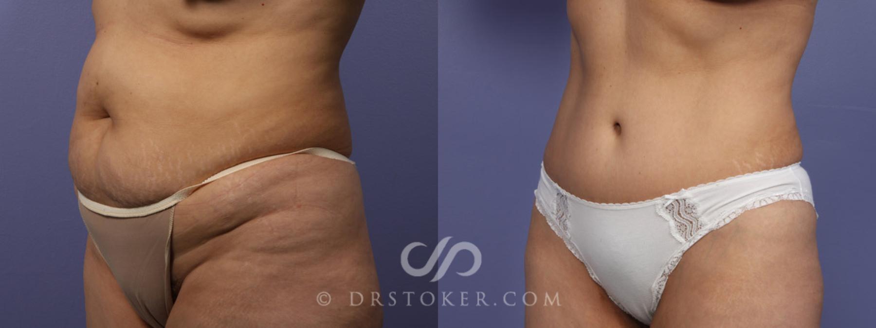 Before & After Tummy Tuck Case 344 View #14 View in Los Angeles, CA