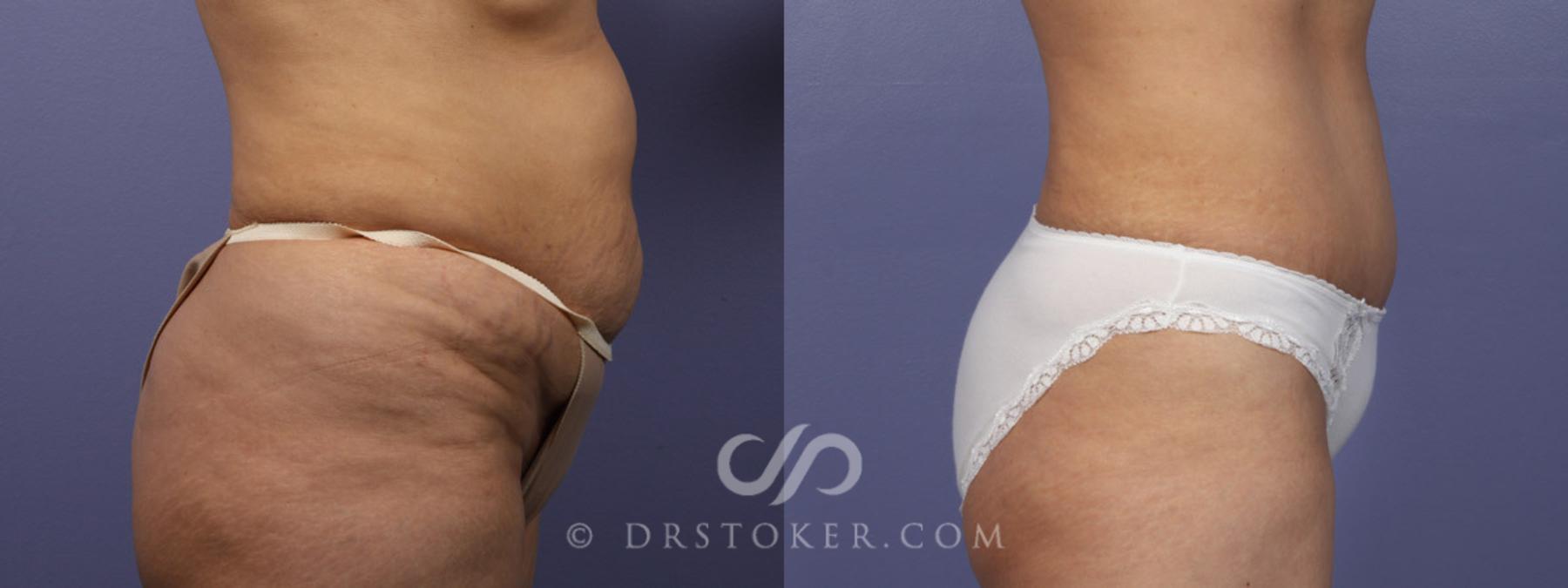 Before & After Tummy Tuck Case 344 View #15 View in Los Angeles, CA