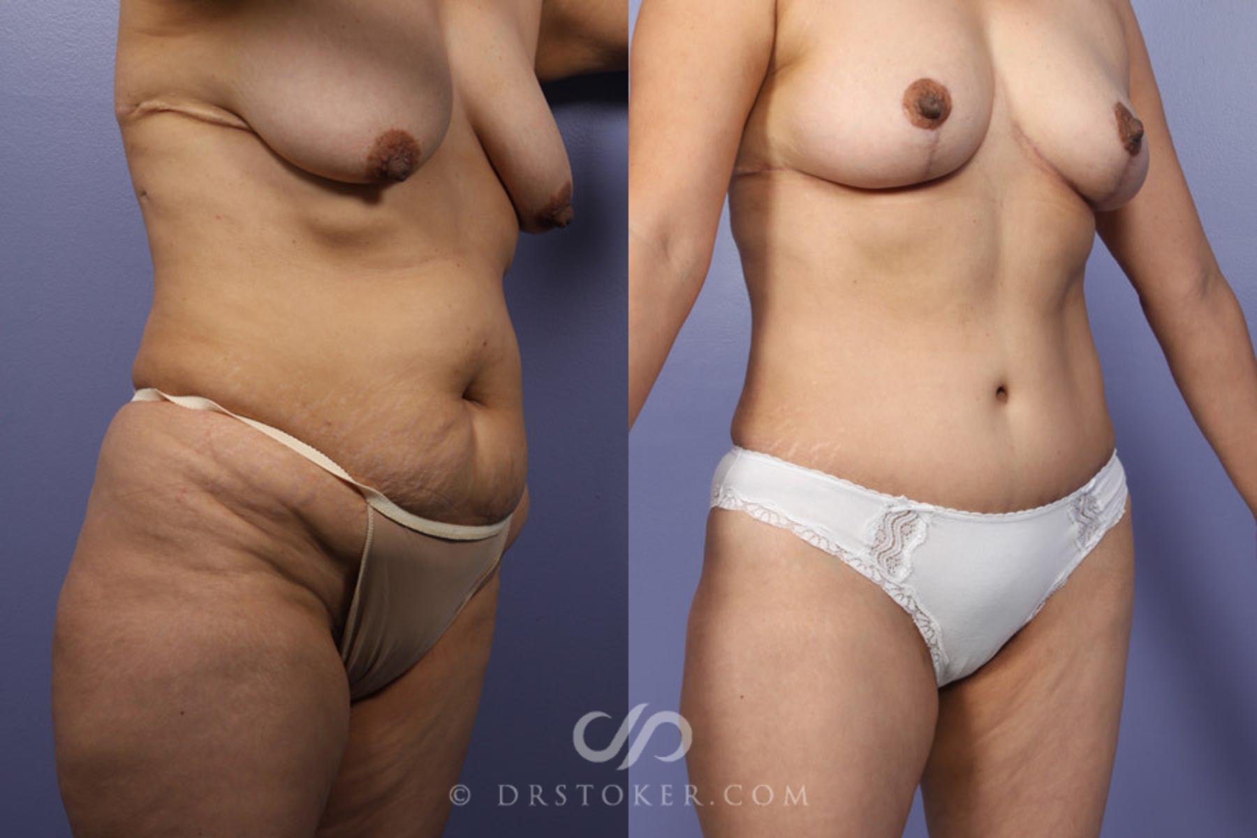 Before & After Tummy Tuck Case 344 View #2 View in Los Angeles, CA