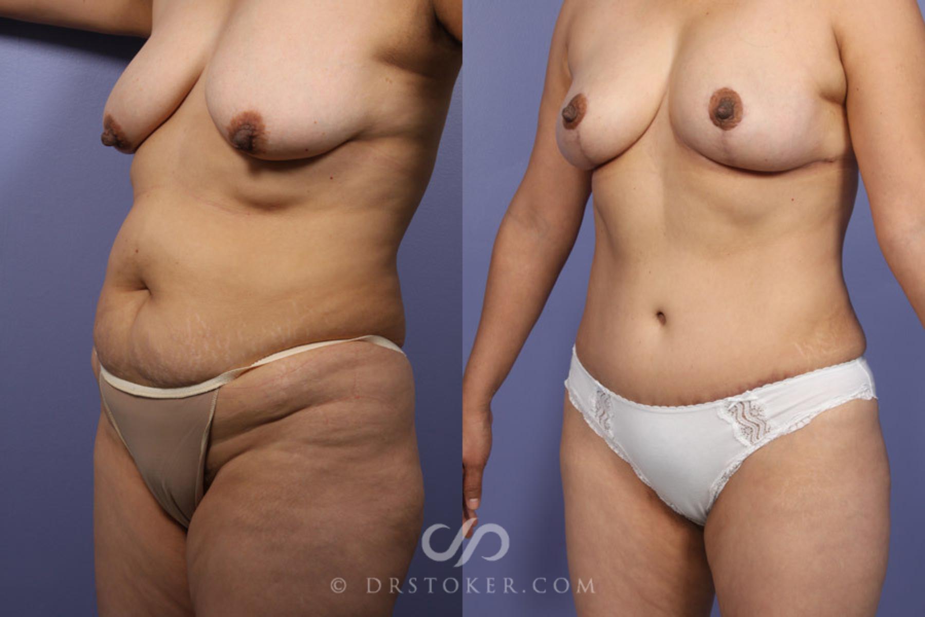 Before & After Breast Lift Case 344 View #3 View in Los Angeles, CA
