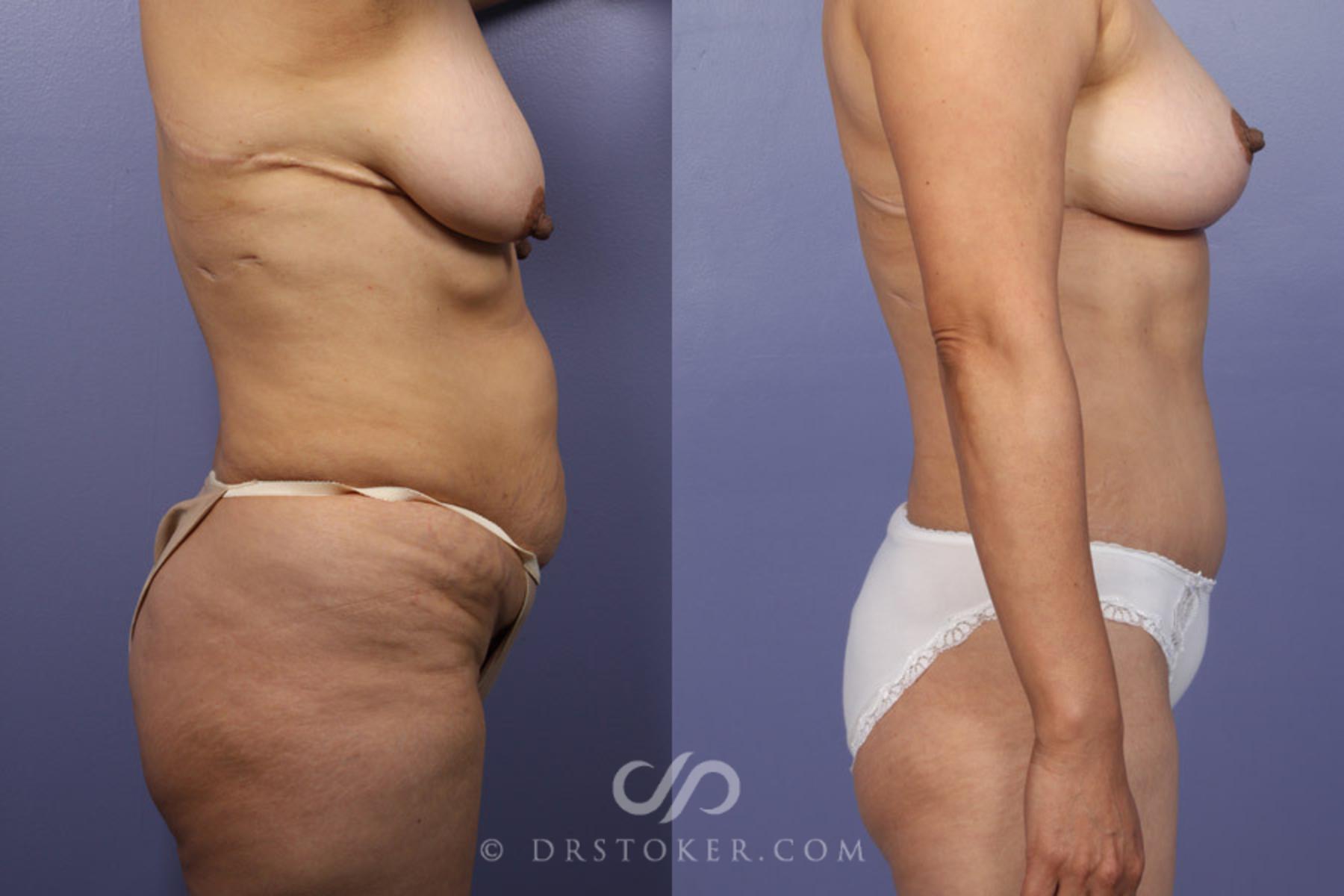 Before & After Breast Lift Case 344 View #4 View in Los Angeles, CA