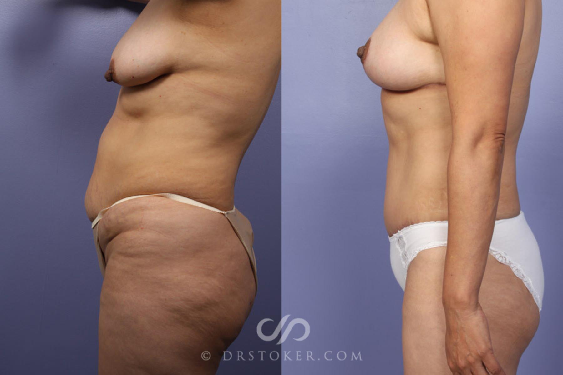 Before & After Breast Lift Case 344 View #5 View in Los Angeles, CA