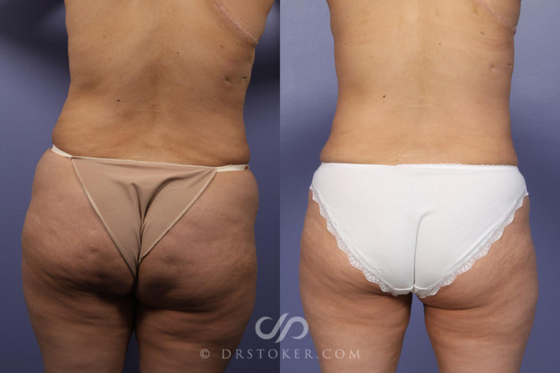 Before & After Tummy Tuck Case 344 View #6 View in Los Angeles, CA