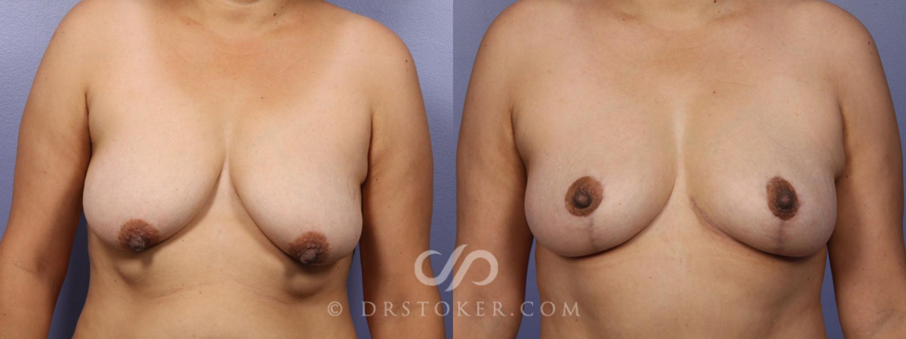 Before & After Tummy Tuck Case 344 View #7 View in Los Angeles, CA