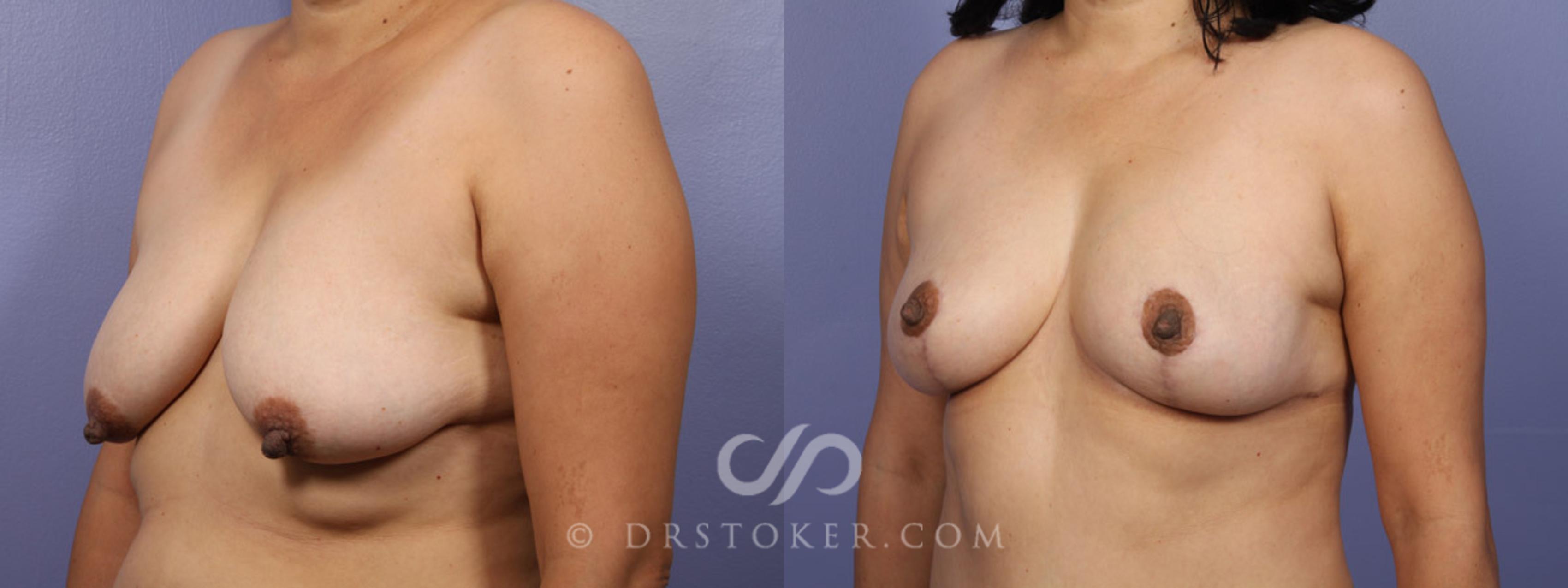 Before & After Tummy Tuck Case 344 View #9 View in Los Angeles, CA